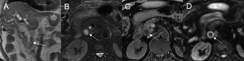 Adenoma in the common bile duct. The plaque-like mass (white arrow) shows isointensity on T2WI (A, B), isointensity on T1WI (C), and hyperintensity on DWI (D). The bile duct lumen at the lesion site is narrow and the diameter of the bile duct is enlarged. Coronal T2WI shows dilatation of the bile duct upstream of the lesion (A).