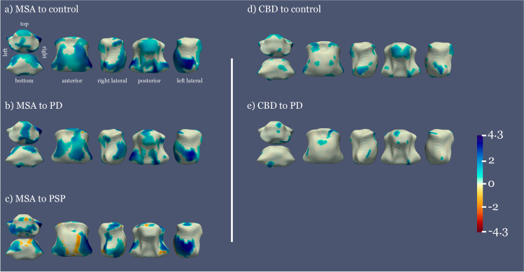 Mean distance between the average shape of each pair of groups, significant results. Color areas represent the distance between average shapes in the regions where significant differences between groups are observed (p < 0.05, FWE corrected). Warm to cold colormap showing areas in blue where the first group is significantly narrower than the second group and red for the opposite case. The vertical barcode represents the distance between groups in millimeters, 4.3 mm being the maximum distance found between the two groups