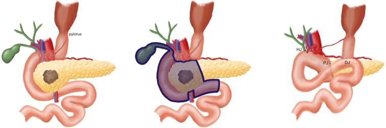 Diagram of the pylorus-preserving pancreaticoduodenectomy procedure (illustration by Stephanie E. Honig).