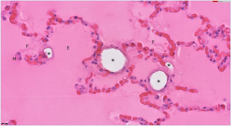 Lung from a dog. Alveoli are filled with eosinophilic, proteinaceous, edema fluid (E) with strands of fibrin (F). A few, foamy alveolar macrophages (M) are present. Several alveolar septa in this field are distended by clear, round, empty spaces (*) that appear to be intravascular and could present extracted lipid emboli. Hematoxylin and eosin stain; bar = 20 μm.