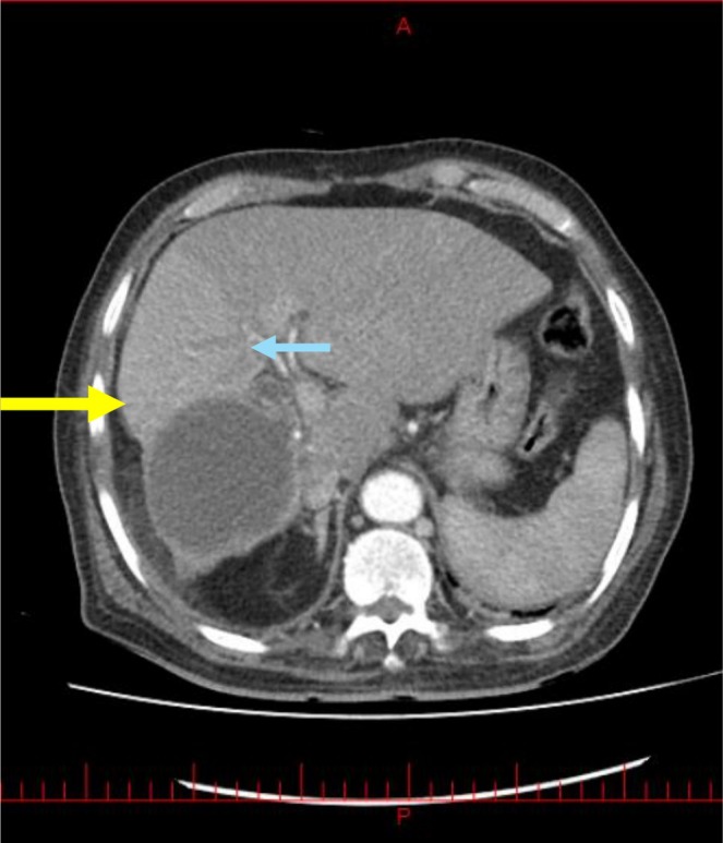 CT of the abdomen (axial view). A hydatid cyst is observed in the right lobe of the liver (yellow arrow), alongside a fistula connecting the cyst to a branch of central biliary tree (blue arrow), which leads to the CBD (green arrow).