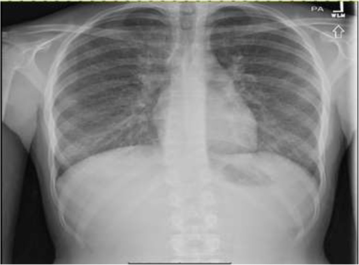 CXR: Coarsening of interstitial lung markings with reticulonodular opacities scattered throughout the lung fields bilaterally