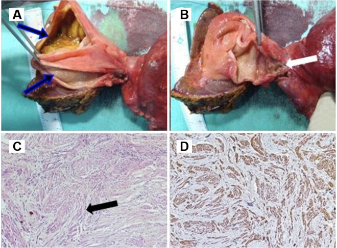 (A) Cut section of resected hepatopancreatic duodenectomy specimen showing septate gall bladder (arrows) (B) and nodular growth at gall bladder neck extending into CBD (arrow). (C) Hematoxylin and Eosin (H&E) stained slide showing nodules with spindle cells (arrow) in the sheets and fascicles surrounding multiple nerve fascicles and ductular structures in the GB wall×100×. (D) Immunohistochemistry shows spindle cells were positive for S100 and NFP indicating neural differentiation. CBD, common bile duct; GB, gallbladder; NFP, neurofilament protein.