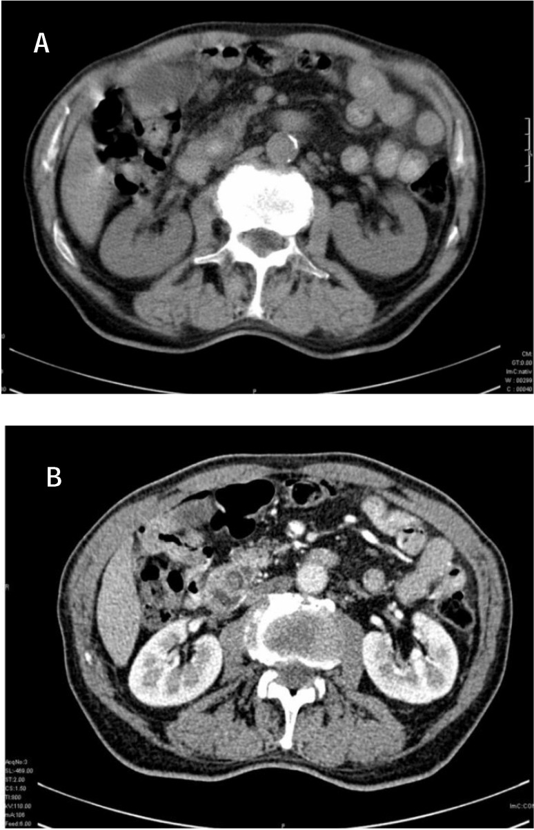 CT non-contrast (a) and contrast enhanced (b). Calculus with CBD dilation