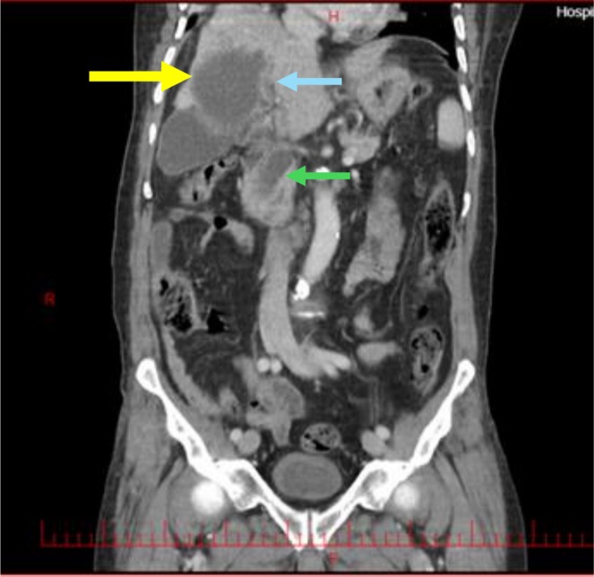 CT of the abdomen (coronal view). A hydatid cyst is observed in the right lobe of the liver (yellow arrow), alongside a fistula connecting the cyst to a branch of central biliary tree (blue arrow), which leads to the CBD (green arrow).