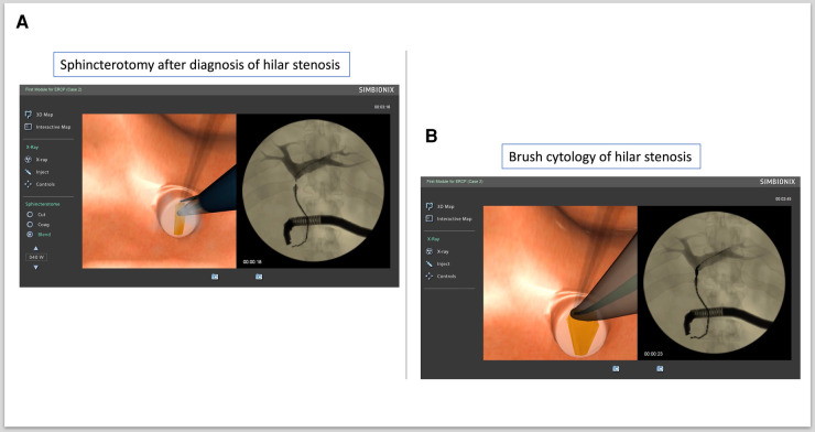 Brush cytology of hilar stenosis. (A) Sphincterotomy after diagnosis of hilar stenosis. (B) Brush cytology of hilar stenosis.