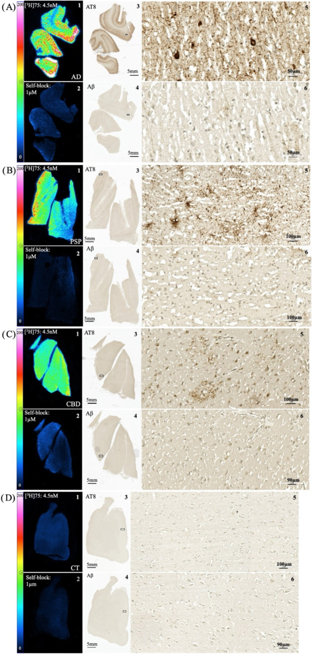 Autoradiographs showing [3H]75 total binding (left upper panel; determined with 4.5 nM [3H]75) and nonspecific binding (left lower panel; determined by blocking with 1 μM 75) of FFPE post-mortem brain sections: AD parietal cortex (A), PSP parietal cortex (B), CBD frontal cortex (C), and healthy control cingulate gyrus (D). Autoradiography color/brightness threshold levels are expressed in counts (0–200). For each case, phospho-tau (AT8 antibody) and Aβ (moC23 antibody) IHC were performed on adjacent sections as pathology reference. Magnification of AT8 and Aβ IHC are shown from areas indicated by squares. In AD brain, (A) the [3H]75 spatial distribution was consistent with the laminar pattern of neurofibrillary tangles (NFTs) and neuropil threads (NTs) (A 3,5); [3H]75 and AT8 IHC concordance was observed in the parietal cortex from PSP (B) and the frontal cortex from CBD (C) brain sections in areas where tufted astrocytes (PSP)(B5) and astrocytic plaques (CBD)(C5) were found. No colocalization was observed with Aβ plaques in AD, PSP, and CBD (A 4,6; B 4,6; C 4,6). Binding of [3H]75 was absent in the cingulate cortex of a healthy control (D).
