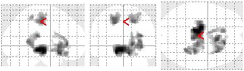 Regions of WM reduction identified on full-factorial analysis among CBS patients, RS patients, and controls. Widespread patterns of WM reduction are mainly identified in the bilateral frontal and limbic subcortical WM and midbrain. The most significant areas of atrophy within the frontal and limbic lobes include the left anterior cingulate and right medial frontal gyrus. The SPM of the f statistics is displayed in a standard format as a maximum intensity projection viewed from the right-hand side (left image), the back (middle image), and the top (right image) of the brain.