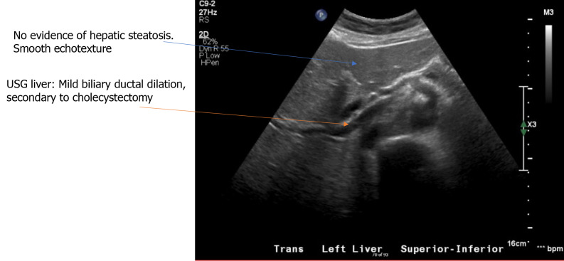 Ultrasonography liver.