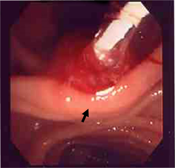 Endoscopic findings during endoscopic balloon dilatation (EBD). The burst balloon of the endoscopic balloon dilatation (EBD) at the site of the biliary sphincter. Arrow indicates the burst balloon of the EBD catheter at the site of the biliary sphincter