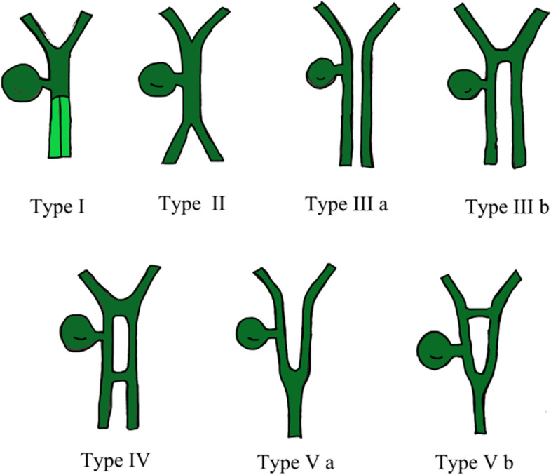 Duplication common bile duct classification proposed by Choi et al. Type I:septum separatting CBD; Type II: CBD bifurcates to drain separately; Type III: double biliary drainage without (a) or with (b) intrahepatic communicating channels; Type IV: double biliary drainage with extrahepatic communicating channels; Type V: single biliary drainage of double commen bile ducts without (Va) or with (Vb) communicating channels