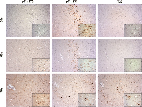 Age dependent tau pathology increases in the hippocampus of controls and is associated with pThr175 tau pathology in the 8th decade of life. Large images taken in the CA2 region of the hippocampus at 10× magnification, inset is same region at 40× magnification