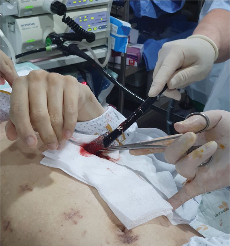 Within the gastrostomy tract, a fully covered self-expanding esophageal metal stent is implanted. An antegrade ERCP is deployed via the stent once it is fully expanded. ERCP = endoscopic retrograde cholangiopancreatography.