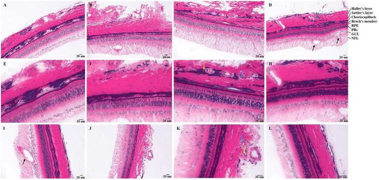 Pathology of tree shrews with choroidal neovascularization (CNV). [A and B (200×), E and F (400×)] Pathology of tree shrew CNV after 7 days of laser photocoagulation. [C and D (200×), G and H (400×)] Pathology of tree shrew after CNV 14 days of laser photocoagulation. [J (200×), I and K (400×)] Pathology of tree shrew CNV after 21 days of laser photocoagulation. [L (400×)] Intact retina and choroid with clear structure of normal tree shrew. The yellow arrow indicates neutrophils, the blue arrow indicates macrophages, the black arrow indicates neovascularization, and the green arrow indicates loose haller’s and sattler’s layer in choroid. RPE, Retinal pigment epithelium; PRs, Photoreceptor; GCL, ganglion cell; and NFL, nerve fiber layer.