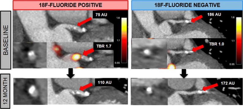 18F-sodium fluoride positron emission tomography to predict progression of coronary calcification. Examples of two patients undergoing 18F-sodium fluoride (18F-NaF) positron emission tomography (PET) and coronary computed tomography angiography at baseline and follow-up. The patient showing uptake of 18F-NaF (18F-fluoride positive) had progression of coronary calcification at follow-up whereas the patient without uptake (18F-fluoride negative) did not show changes. Reproduced with permission from Doris et al12
