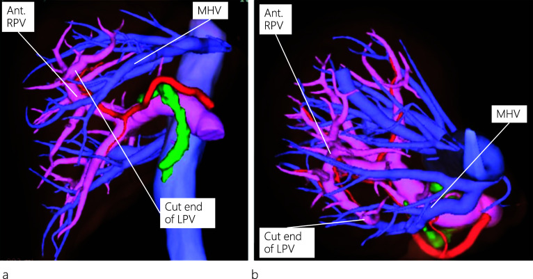 Three-dimensional reconstruction of postoperative enhanced CT images. Both the MHV and Ant. RPV are preserved, as viewed from neutral (a) and left posterior oblique (b) positions. CT: computed tomography; MHV: middle hepatic vein; Ant. RPV: anterior right portal vein; LPV: left portal vein