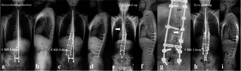 a 26-year-old male patient with NF1 related lumbar kyphoscoliosis associated with CCI (lumbar type) (a, b). Posterior spinal correction and fusion surgery was performed with over correction of upper hemi-curve, resulting in iatrogenic aggravation of CCI (c). Despite spontaneous improvement of CCI during follow-up (e), rod fracture occurred at 2-year-follow up (e, f, g, arrow). Revision surgery was performed with satellite rods (four rod constructs) and generous posterior fusion, and no additional rod fracture occurred by 5-year-follow up (h, i)