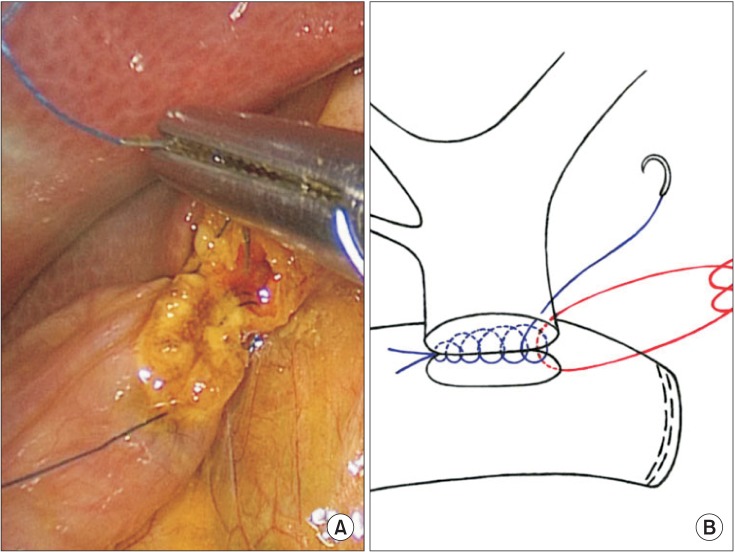 (A) Posterior wall suture of choledochojejunostomy. (B) Schematic illustration.