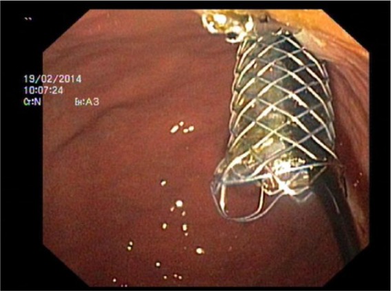 Endoscopic view of a transhepatogastric fully covered self-expanding metal stents (FCSEMS) with bile outflow inserted through the posterior and upper gastric wall and stitched with a clip to the mucosa.