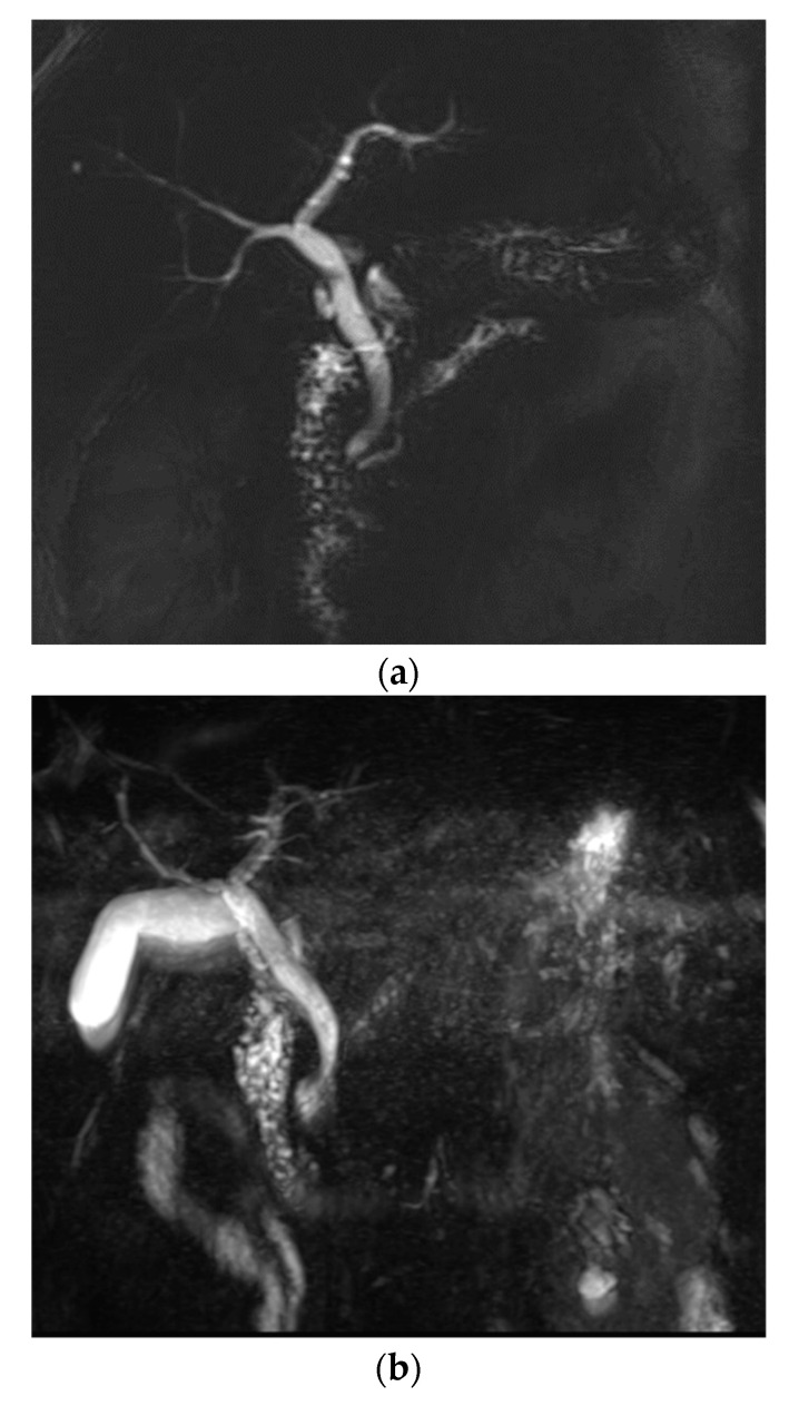 A 57-year-old male with chronic pancreatitis. A 2D thick-slab MRCP (a), as a reference standard, clearly depicts dilated pancreatic duct with multiple filling defects, compatible with chronic pancreatitis. Overall image quality was comparable between conventional MRCP (b) (score 3) and optimized BH-CS-MRCP (c) (score 3). However, image degradation by artifacts (3 vs. 4.5) and background suppression (3 vs. 3.5) was better with optimized BH-CS-MRCP. The pancreatic duct is well depicted on optimized BH-CS-MRCP, while it is hardly recognized on conventional MRCP. In addition, the visibility of CBD and IHD was all better with optimized BH-CS-MRCP, except for the Rt 2nd level IHD (4 vs. 1).