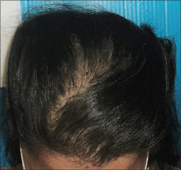 Female– Day 180-37 hairs/cm2