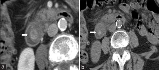 A 77-year-old woman having obstructive jaundice. (a) IV contrast-enhanced transverse MDCT with no positive intraduodenal contrast demonstrating a distally impacted rim-like calcified stone (straight arrow), which was detected by both observers. (b) The stone was seen on the transverse precontrast CT acquisition (straight arrow). The ERCP 3 days later showed no stones. The third reader concluded that this stone had likely passed in the interim