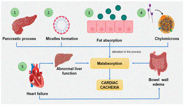 Cardiac cachexia, malabsorption syndrome and factors that favor them. (1) Hydrolysis of dietary triglyceride by pancreatic lipase. (2) The resulting fatty acids and monoglycerides then combine with bile salts from the liver to form micelles. (3) Dietary fats are absorbed across the mucous membrane into the intestinal cell. (4) The triglycerides are resynthesized and then incorporated into chylomicrons and transferred to the lymphatic system. (5) Heart failure generates alterations in hepatic functioning and bowel wall edema that favor malabsorption syndrome and, consequently, cardiac cachexia.
