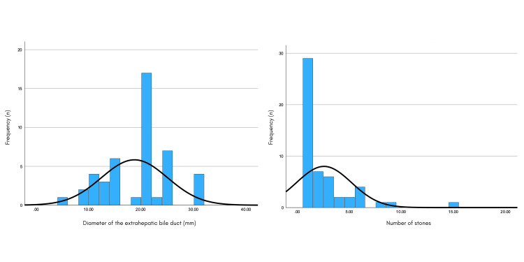 Distribution of the diameter of the extrahepatic bile duct and number of stones in GC.GC: giant choledocholithiasis