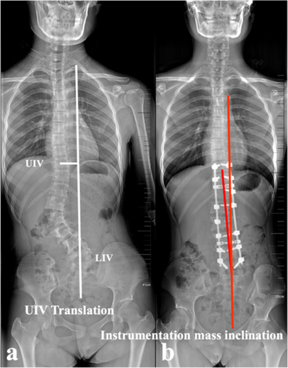 Illustration of the measurements of UIV translation (a) and instrumentation mass inclination (b)