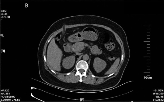A stone in common bile duct and there is a Hem-o-lok clip within it