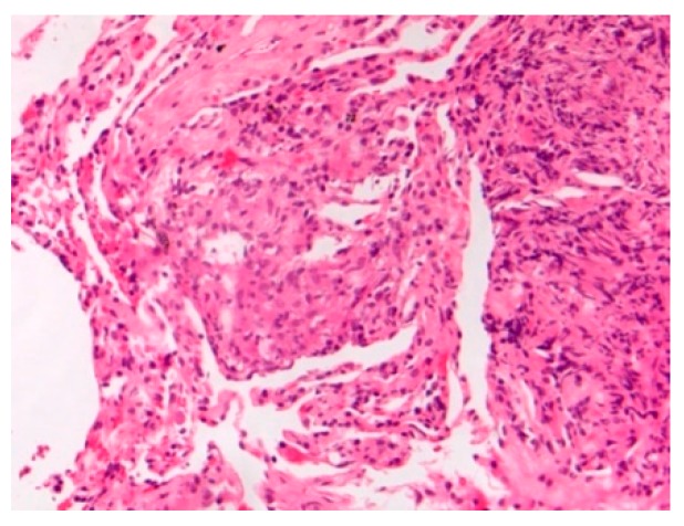 Lung sarcoidosis young E-cig vaper. H&E. Magnification 200×.