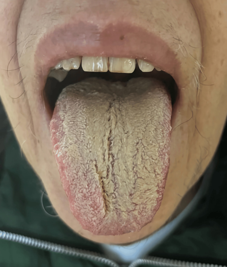 Black hairy tongue on the day of complete discontinuation of olanzapine.Consent to publish the image was obtained from the patient.