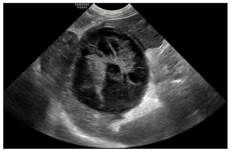 Sagittal ultrasonographic image of a gall bladder mucocele with multiple hyperechoic areas with a stellate appearance in an 8-year-old female neutered border terrier.