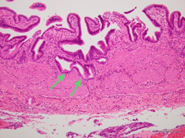Histopathological findings of the gallbladder. The Rokitansky–Aschoff sinus (arrows) is identified in the wall of the cystic structure. The pathological diagnosis of the cystic structure is of an ectopic gallbladder