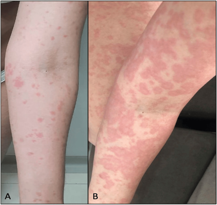 A: Erythematoedematous papules after CBD use. B: Evolution after two days during which CBD was discontinued and oral prednisone was initiated.CBD: cannabidiolSource: Souza JD, Fassoni-Ribeiro M, Batista RM, et al.: Case Report: Cannabidiol-Induced Skin Rash: A Case Series and Key Recommendations. Front Pharmacol. 2022, 13:881617. 10.3389/fphar.2022.881617 [5]Image taken from an open-access article distributed under the terms of the Creative Commons Attribution License. The use, distribution, or reproduction in other forums is permitted, provided the original author(s) and the copyright owner(s) are credited and that the original publication in this journal is cited, in accordance with accepted academic practice. Attribution and permission obtained.
