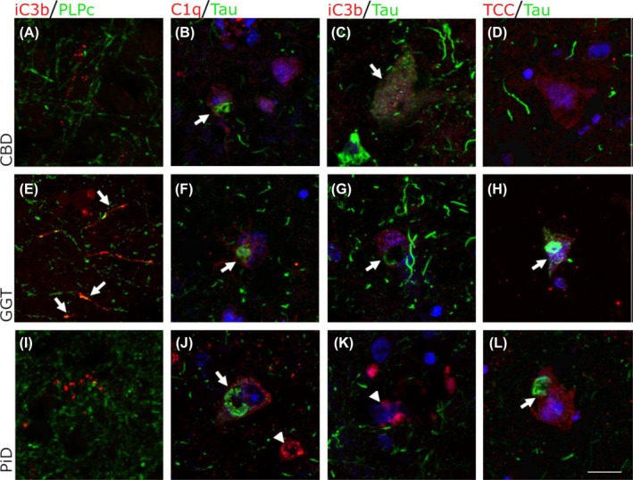 Co‐localisation of complement proteins with tau and myelin in CBD, GGT and PiD. (A), (E), (I): Double labeling of myelin marker PLPc (Green) with C3b/iC3b (Red). C3b/iC3b was observed co‐localised with PLPc in GGT cases only (E, arrows) but not CBD (A) or PiD (I). (B), (F), (J): Double labeling of C1q (red) with AT8 tau (green), Hoechst (Blue). C1q was observed on neurons both with tau (arrows) and without tau inclusions (arrowhead). (C), (G), (K): Double labelling of C3b/iC3b (red) with AT8 tau (green), Hoechst (Blue). C3b/iC3b was observed on some tau positive neurons in CBD (C, arrow) and on some tau positive cells in GGT (G, arrow). C3b/iC3b was also found on neurons in PiD that did not have tau inclusions (K, arrow). (D), (H), (L): Double labelling of TCC (red) with AT8 tau (green), Hoechst (Blue). TCC immunostaining was found in all tauopathy subtypes, including on neurons with tau positive inclusions (H, L arrows). Scale bar = 20 μm.