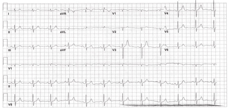 EKG done at 06:56 on day 1 of admission, showing borderline EKG with nonspecific intraventricular conduction block. EKG = electrocardiogram