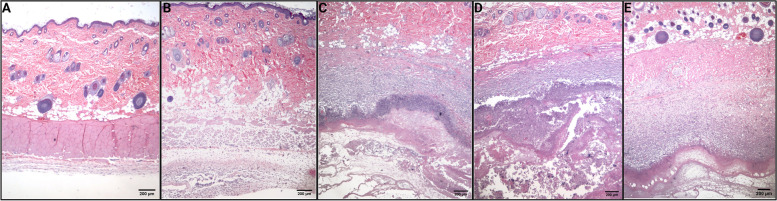 H&E staining of skin samples from treated rats. A Saline. B Propylene glycol. C CBD only. D THC only. E CBD + THC. A Saline: normal skin, no significant inflammation. B Propylene glycol: extensive superficial and deep neutrophilic inflammation with associated granulation tissue. C CBD only: ranging from granulation tissue and palisading neutrophilic abscess with necrobiosis, debris, and surface bacterial infection to ulcer and full-thickness cutaneous necrosis. D THC only: granulation tissue and palisading neutrophilic abscess with necrobiosis and debris. E CBD + THC: granulation tissue and palisading neutrophilic abscess with necrobiosis and debris