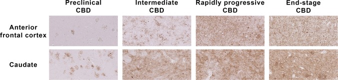 Tau Immunohistochemistry (AT8) Sections of Preclinical (Case 1; Ling et al. Brain 2016), Intermediate and Rapidly Progressive (RP-Case 4) and End-Stage CBD (ES-Case 11) Cases (× 10 objective)