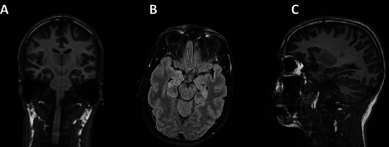 Ten-day post-onset MRI: The imaging study, comprising coronal, axial, and sagittal views from left to right, encountered motion artifacts during acquisition, particularly affecting the FLAIR sequence. FLAIR sequences show signs of alterations in both globus pallidi, the cerebellum, and the hippocampi (B). An apparent alteration of the signal in both globus pallid can be observed. The cerebellum, hippocampi, and globus pallidum show uptake suggestive of toxic-metabolic-ischemic encephalopathy
