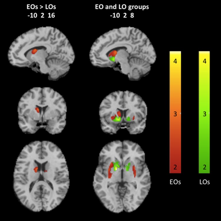 Neural responses to backward-masked cannabis cues compared to neutral cues in the striatum of early and LO cannabis users (p<0.01, k>50 voxels). Representative fMRI sagittal, axial, and coronal brain slices analyzed in SPM8 and overlain on the MNI brain. Data are displayed neurologically (left is left). The color bars, which represent T values, indicating greater dorsal striatal responses in EOs are shown in red to yellow hues, and greater ventral striatal responses in LOs are shown in green to yellow hues. An interactive visual display of all brain data in all three planes can be found at http://franklinbrainimaging.com. EO, early onset; LO, late onset; SPM8, statistical parametric mapping.