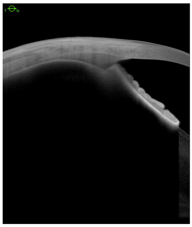 Anterior segment swept-source OCT with normal ciliary body structure.