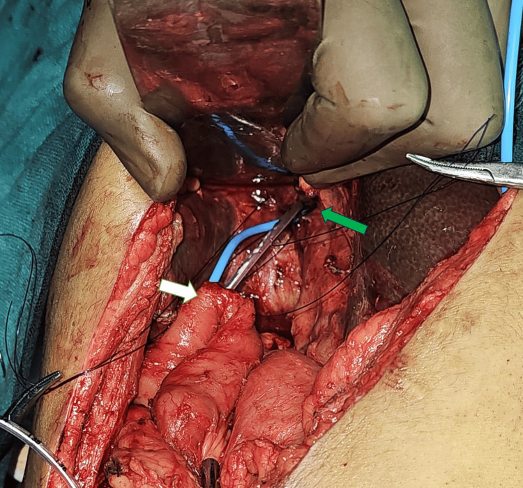 Ultrasound-guided transhepatically placed biliary stent (blue catheter) seen emerging through the left hepatic duct at the porta. Infant feeding tube (white catheter) placed into the right hepatic duct.White arrow: Roux limb; green arrow: porta hepatis at the undersurface of the liver