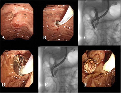 a Difficult biliary cannulation was due to failure of 10 attempts at duodenal papilla; (b) Limited precut sphincterotomy was performed with the extent of cutting was less than half the length of the papillary mound; (c) Common bile duct stone was found after successful biliary cannulation; (d) Endoscopic papillary balloon dilation was performed after limited precut sphincterotomy; (e and f) Common bile duct stone was extracted by retrieval balloon