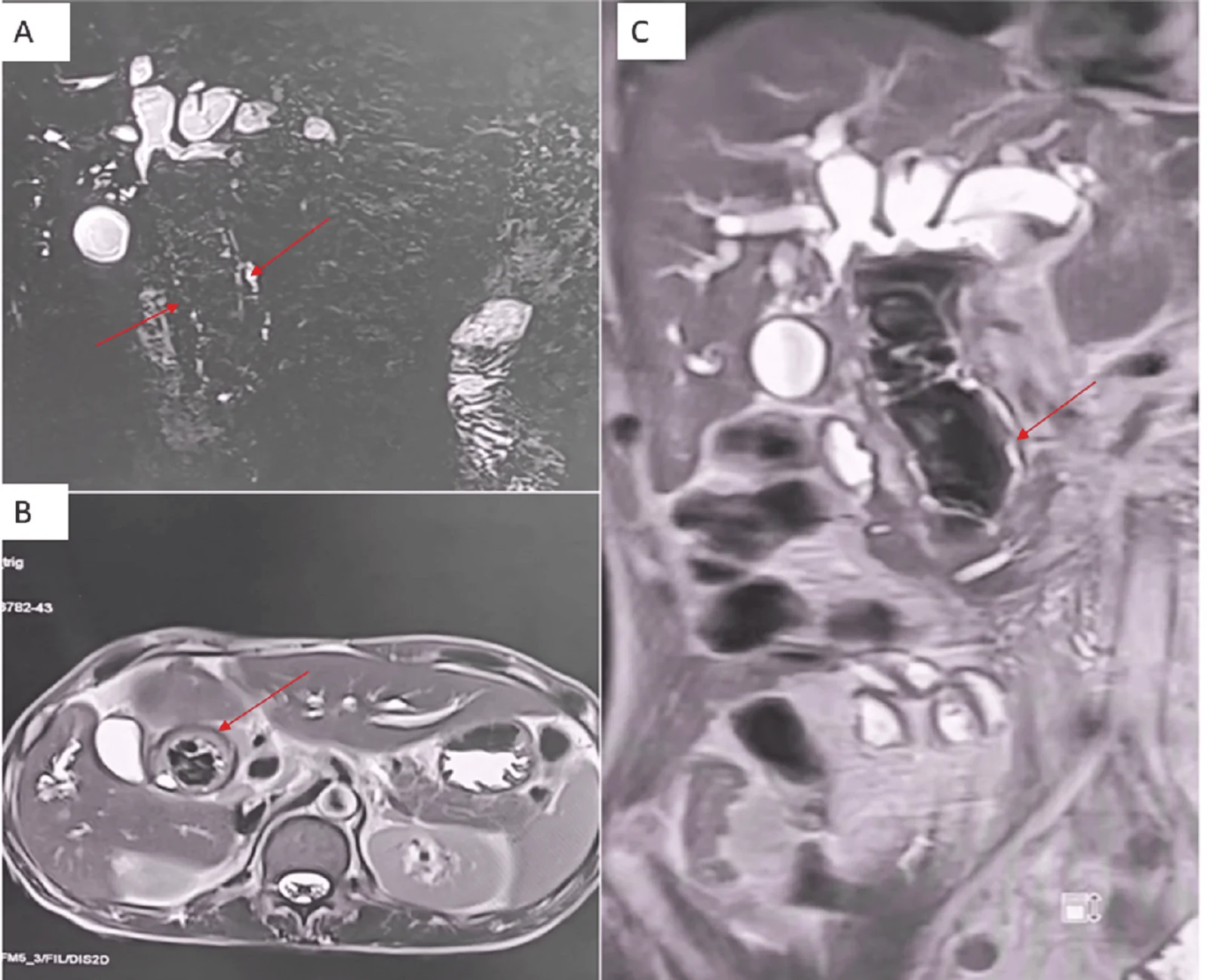 Magnetic resonance cholangiopancreatography (MRCP) images.(A) Heavily T2-weighted MRCP image showing a linear intraductal signal void within the common bile duct (red arrows) with surrounding intraductal filling defect. (B) Axial T2-weighted image demonstrating a rounded hypointense intraluminal lesion within a dilated CBD (red arrow). (C) Coronal MRCP image showing CBD dilatation with a central linear signal void and adherent filling defect (red arrow), causing biliary obstruction.CBD: common bile duct