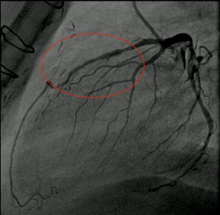 In- Stent restenosis of LAD