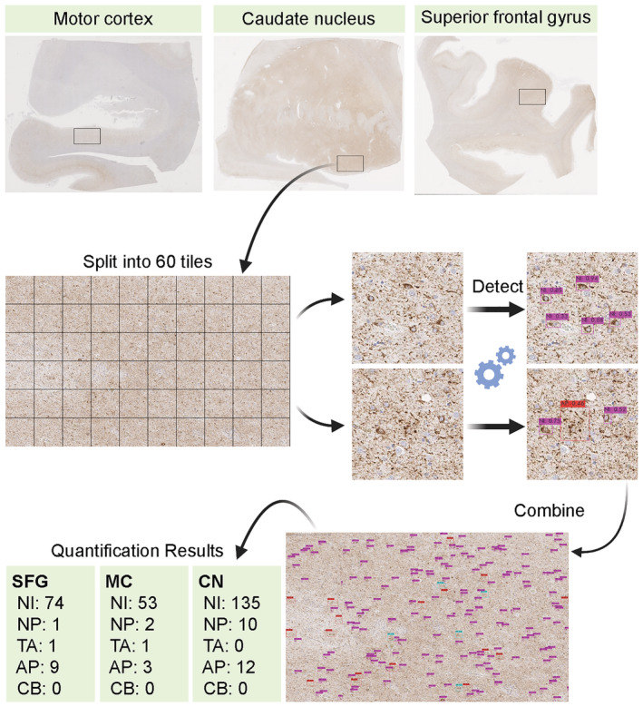 Flowchart of tau burden quantification. CP13‐stained slides from the motor cortex, caudate nucleus and superior frontal gyrus from a corticobasal degeneration (CBD) case are shown. A region of interest (5000 × 3000 pixels) is captured and split into 60 tiles. Each tile is processed for object detection, and all tiles are combined into one original image with predicted labels. Abbreviations: AP, astrocytic plaques; CB, coiled bodies; CN, caudate nucleus; MC, motor cortex; NI, neuronal inclusions; NP, neuritic plaques; SFG, superior frontal gyrus; TA, tufted astrocytes