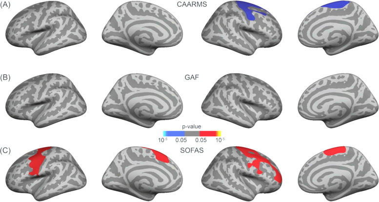 Corrected correlation maps between grey matter thickness and (A) CAARMS composite score, B GAF and C SOFAS scores for the ARMS cohort. A frontal–temporal mask was used, and multiple comparison correction was performed using permutation testing of 100,000 tests with a cluster-forming threshold of p < .05 and cluster-wise threshold of p < .05 with an additional Bonferroni correction to take both hemispheres into account. (Red = positive and blue = negative correlations between grey matter thickness and CAARMS composite and SOFAS scores)