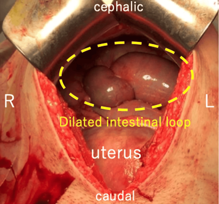 Intra-abdominal findings.An enlarged intestinal loop in the upper abdomen is noted.