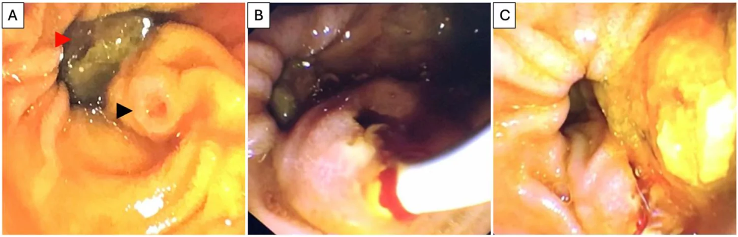 Photographs of ERCP showing: (A) trapped food debris within the periampullary diverticulum (red arrowhead) posterocranial to the ampulla of Vater (black arrowhead); (B) an endoscopic CBD balloon sweep after sphincterotomy yielding clear bile, minimal sludge, and no bile duct stones; and (C) dislodged food debris following the balloon sweep with free-flowing bile.